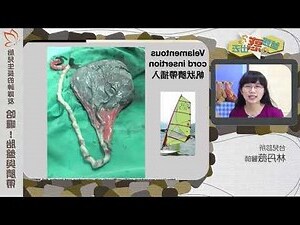 帆狀胎盤