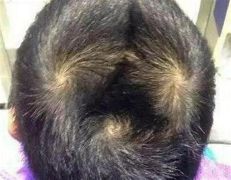 頭髮漩渦方向