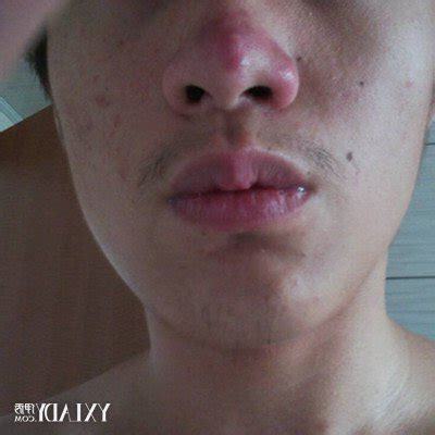 鼻子红是什么原因
