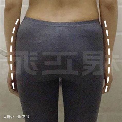 臀型分析