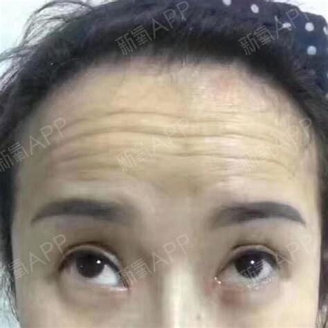 額頭有皺紋