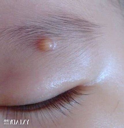 眉毛痘痘