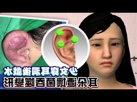 耳洞爛掉