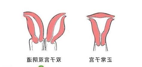 雙陰畸形