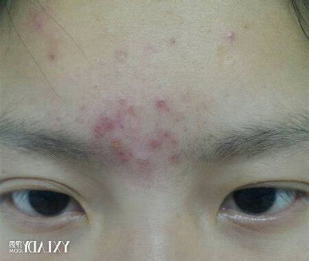 眉心痘怎麼消