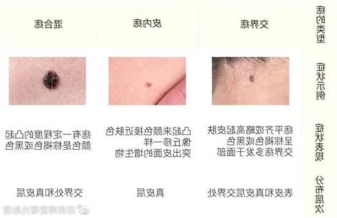 痣是什麼
