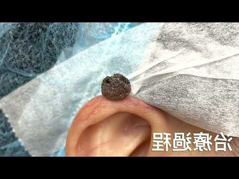 突出來的痣