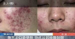 額頭生粒粒原因