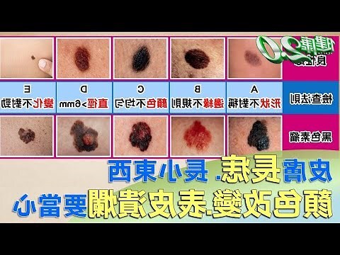 胸部咖啡色痣