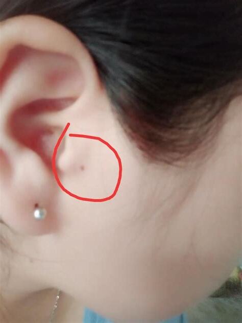 耳根痣
