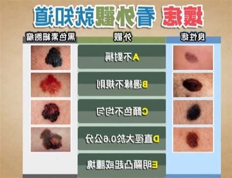 腋下痣癌