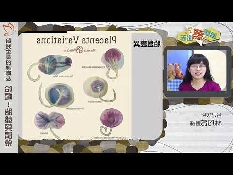 前置胎盤剝離