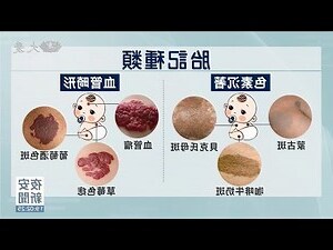 新生兒胎記