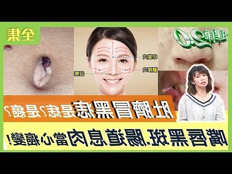 肚臍長痣