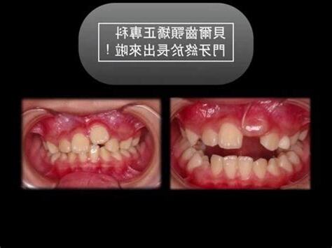 門牙掉了多久會長