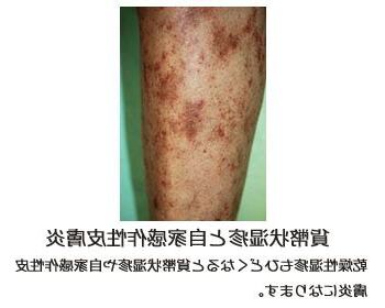 皮膚病