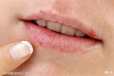 上唇長痘痘