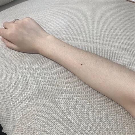 手臂生白毛