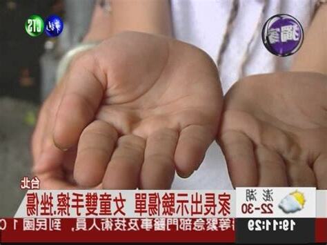 手捶牆壁腫起來