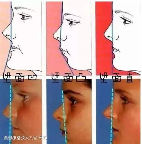 凹陷