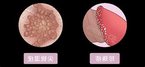 龜頭下緣