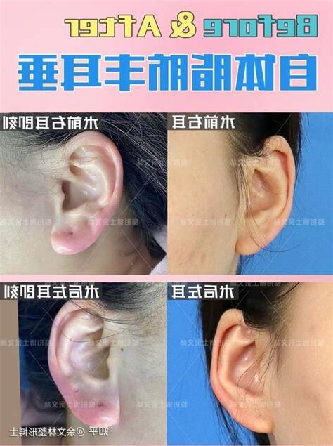 耳垂太厚耳洞穿不過去
