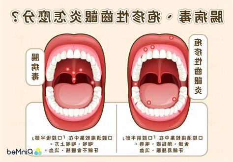 喉嚨長一顆痘痘