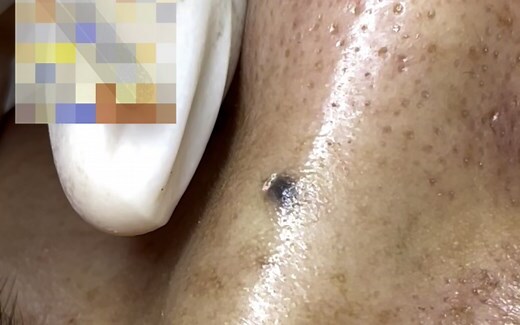 鼻子黑痣