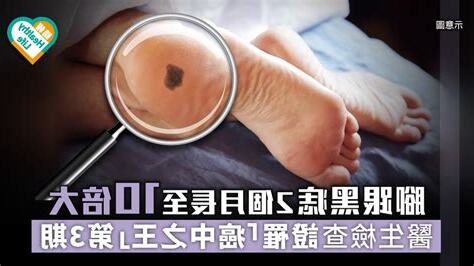 腳跟有痣