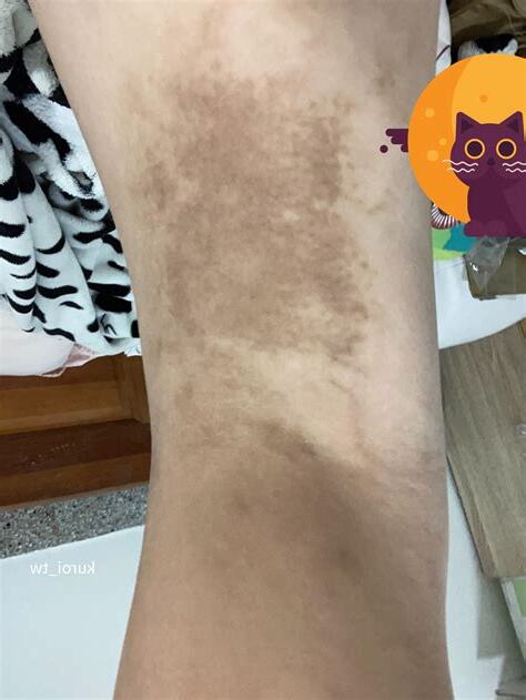 大腿外側胎記