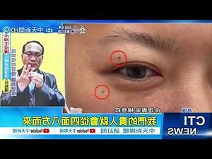眼皮有痣男