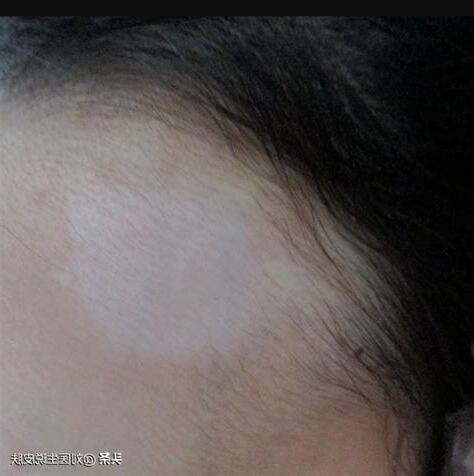 額頭白毛