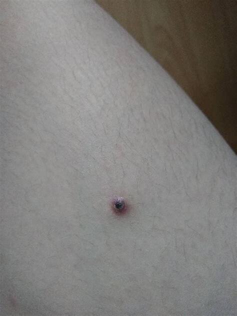 大腿根有痣