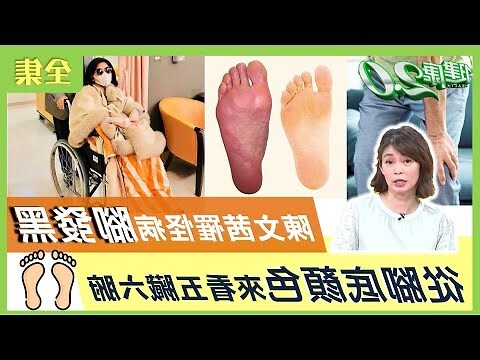 腳背黑斑