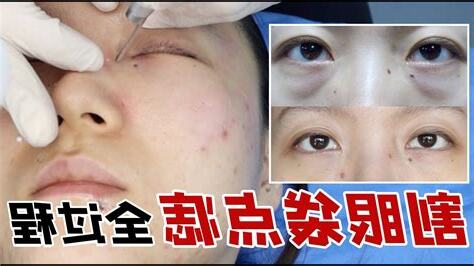 眼袋痣