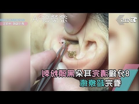 耳邊生瘡