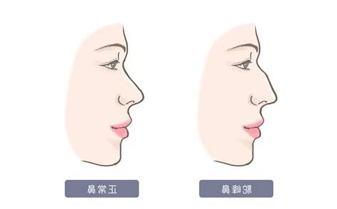 聳鼻