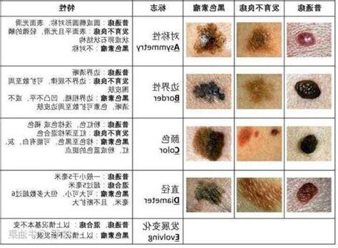 黑色素痣原因