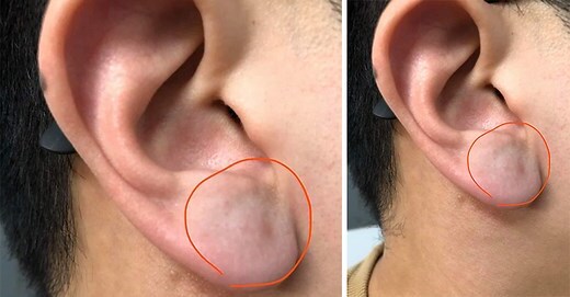 耳垂腫起來會痛