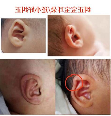 外翻耳