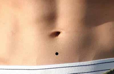肚臍周圍有痣