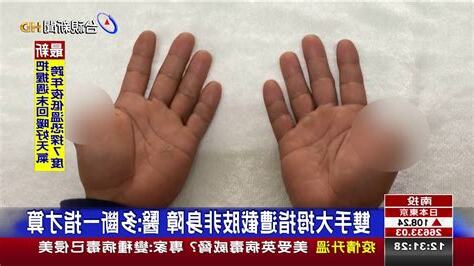大拇指斷掉
