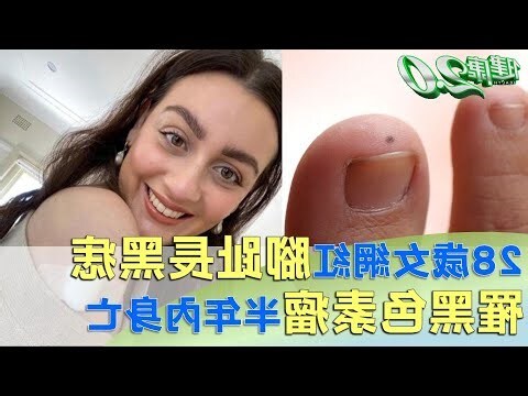 腳趾縫有痣
