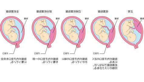 低位性前置胎盤