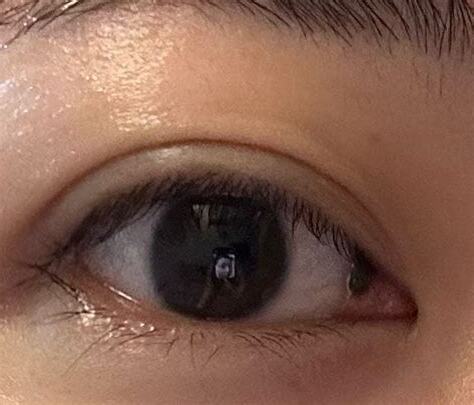 頭側有痣
