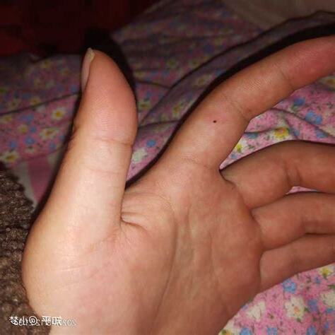 中指突然長痣