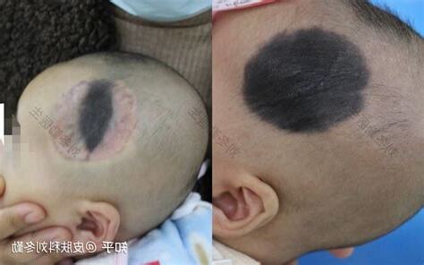 毛痣