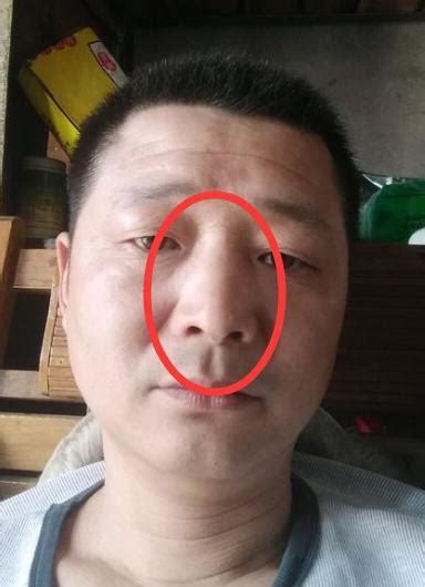 男人鼻子紅