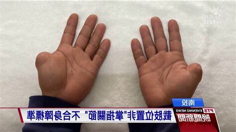夢到無名指斷掉