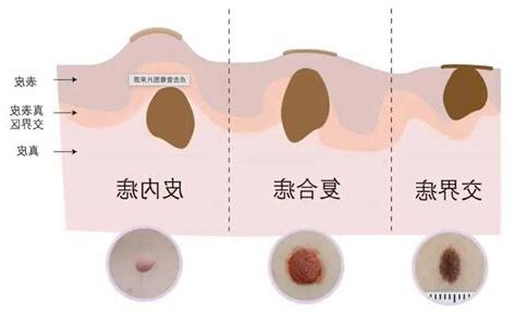 生殖有痣